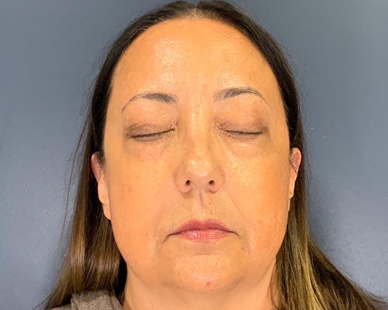 Blepharoplasty Before & After Gallery - Patient 384811 - Image 3