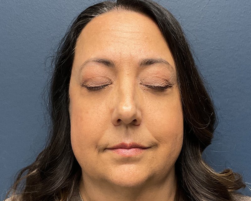 Blepharoplasty Before & After Gallery - Patient 384811 - Image 4