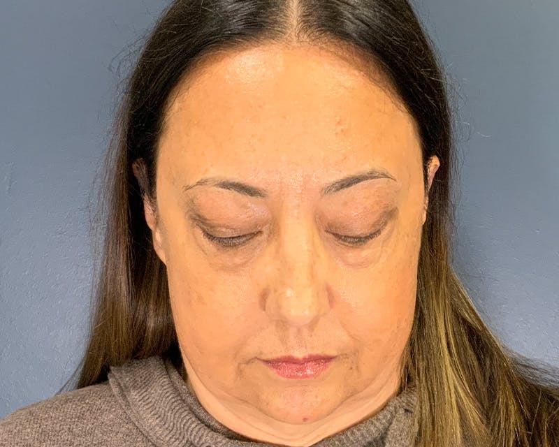 Blepharoplasty Before & After Gallery - Patient 384811 - Image 5