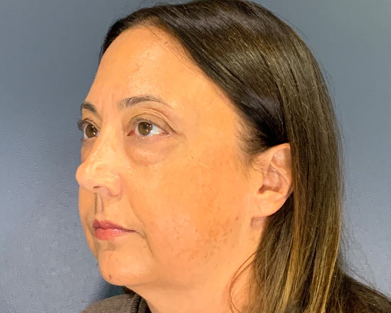 Blepharoplasty Before & After Gallery - Patient 384811 - Image 7