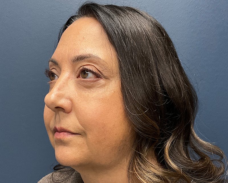 Blepharoplasty Before & After Gallery - Patient 384811 - Image 8