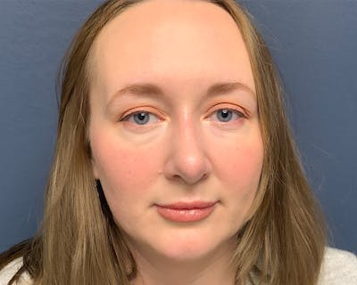 Rhinoplasty Before & After Gallery - Patient 246172 - Image 2