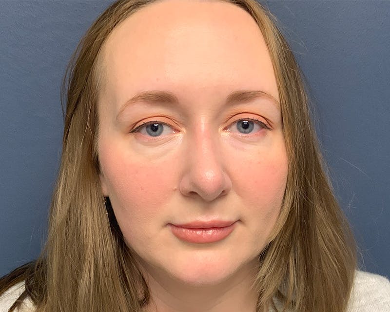 Rhinoplasty Before & After Gallery - Patient 246172 - Image 2