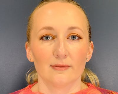 Rhinoplasty Before & After Gallery - Patient 246172 - Image 1