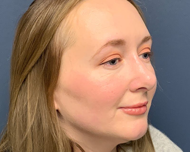 Rhinoplasty Before & After Gallery - Patient 246172 - Image 4