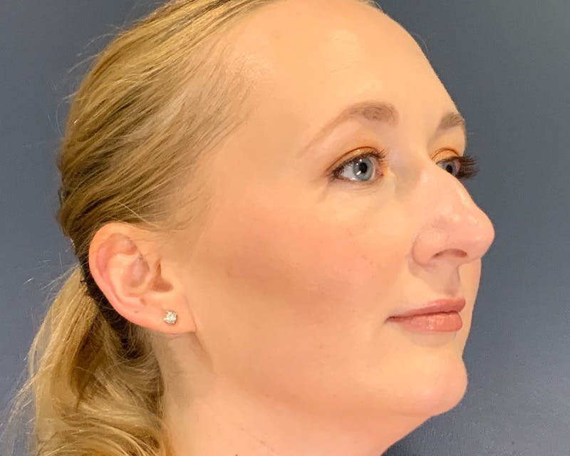 Rhinoplasty Before & After Gallery - Patient 246172 - Image 3
