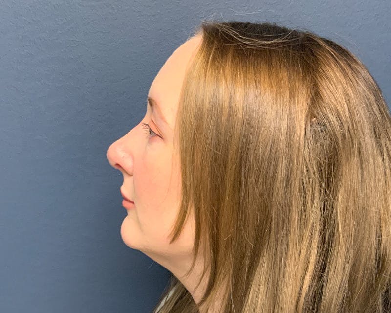 Rhinoplasty Before & After Gallery - Patient 246172 - Image 6