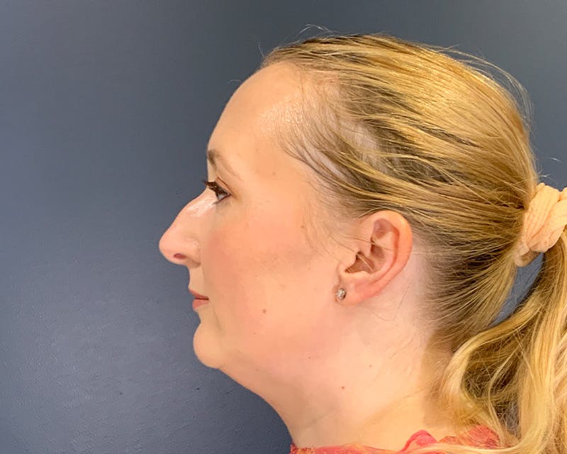 Rhinoplasty Before & After Gallery - Patient 246172 - Image 5