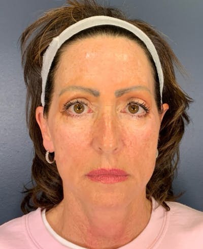 Face Lift Before & After Gallery - Patient 829941 - Image 1