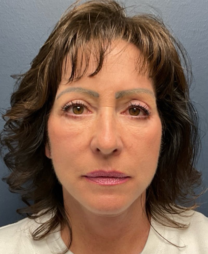 Face Lift Before & After Gallery - Patient 829941 - Image 2
