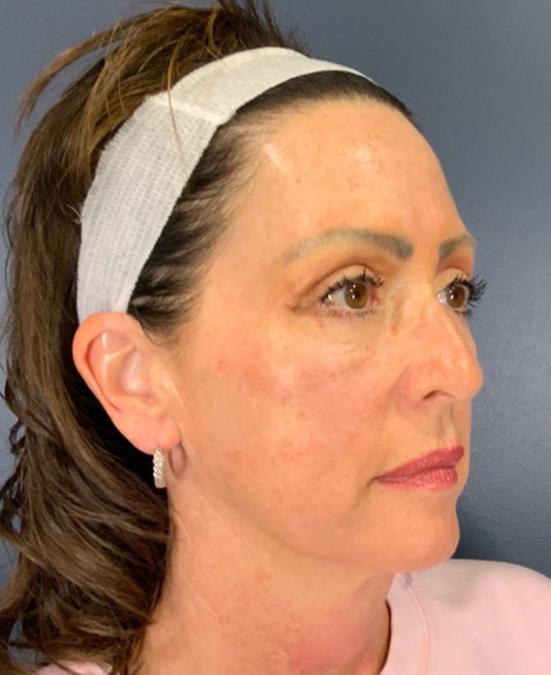 Face Lift Before & After Gallery - Patient 829941 - Image 3