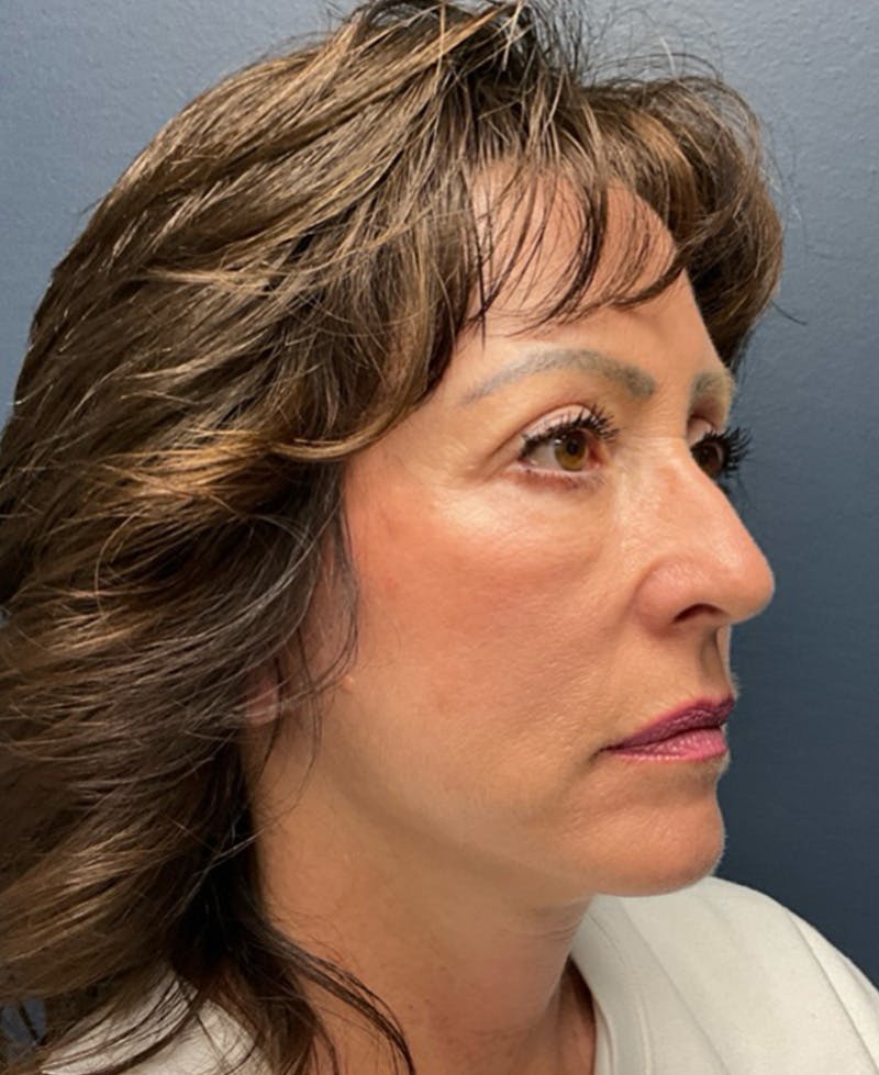 Face Lift Before & After Gallery - Patient 829941 - Image 4
