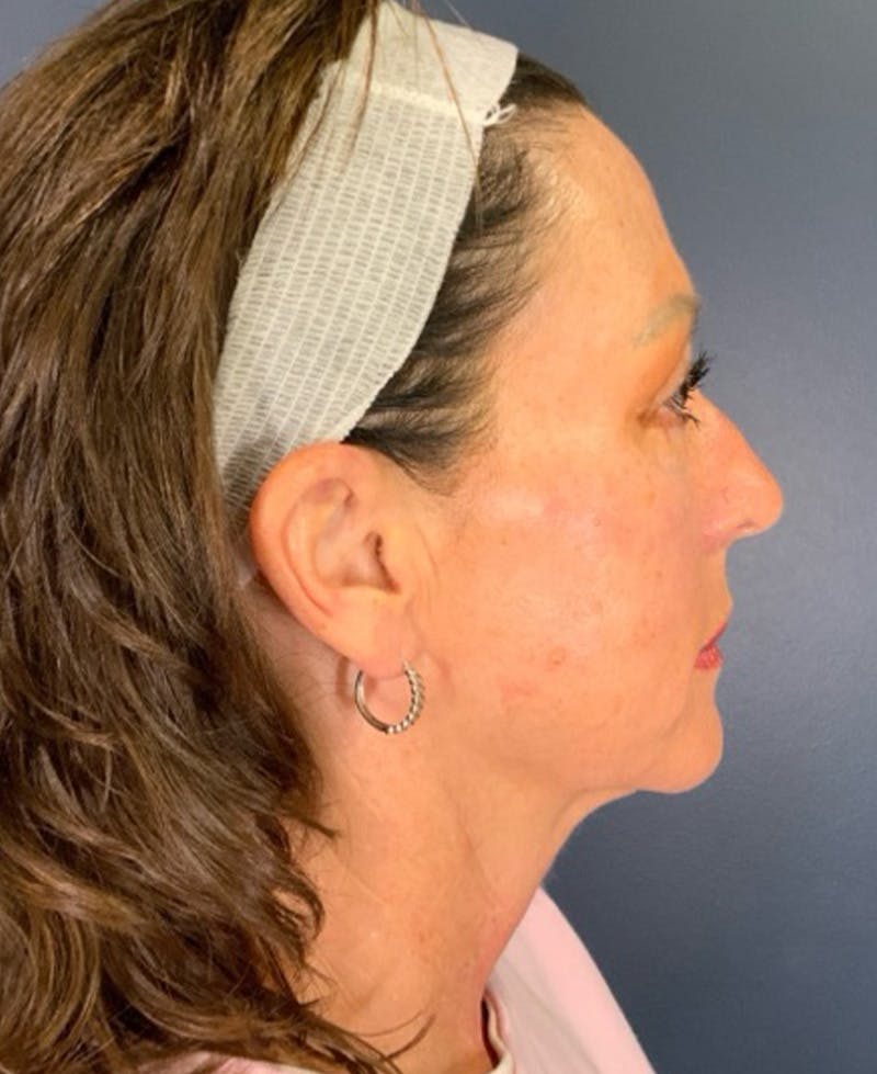 Face Lift Before & After Gallery - Patient 829941 - Image 5