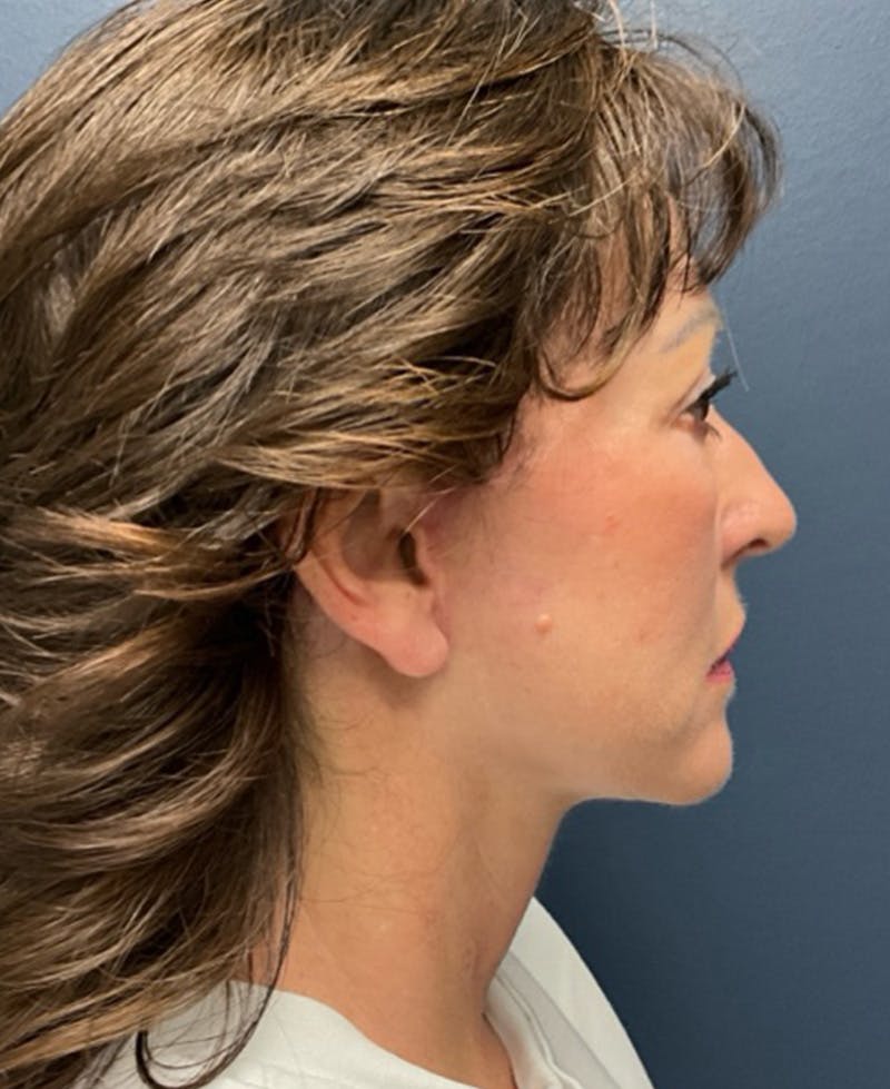 Face Lift Before & After Gallery - Patient 829941 - Image 6