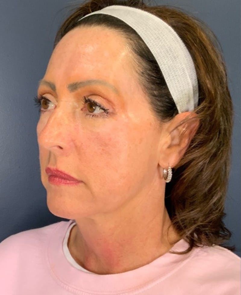 Face Lift Before & After Gallery - Patient 829941 - Image 7