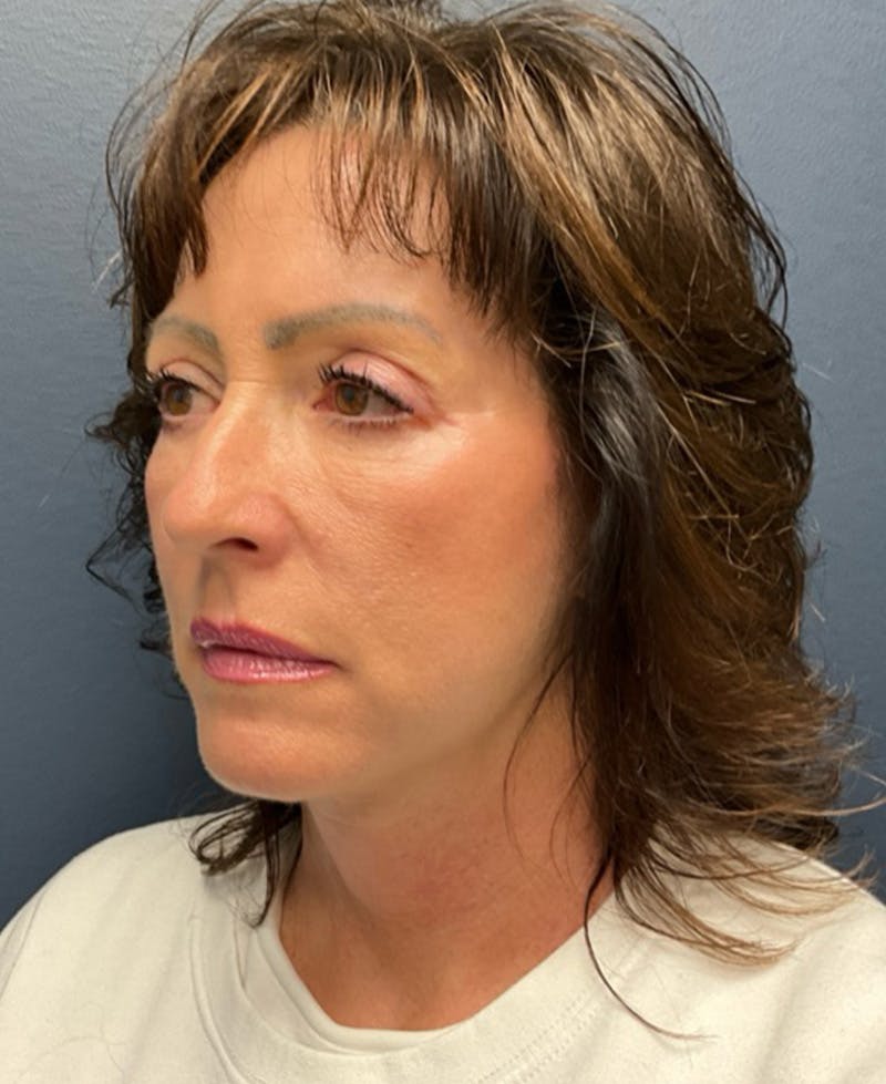 Face Lift Before & After Gallery - Patient 829941 - Image 8