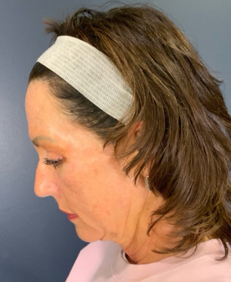 Face Lift Before & After Gallery - Patient 829941 - Image 9
