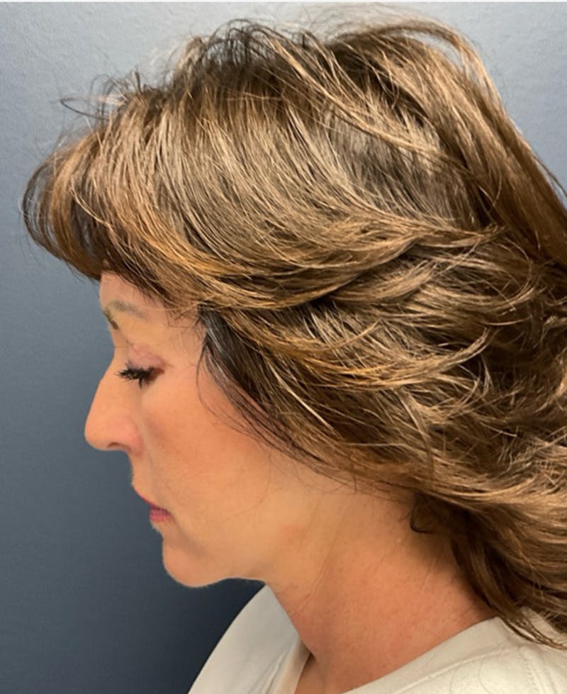 Face Lift Before & After Gallery - Patient 829941 - Image 10