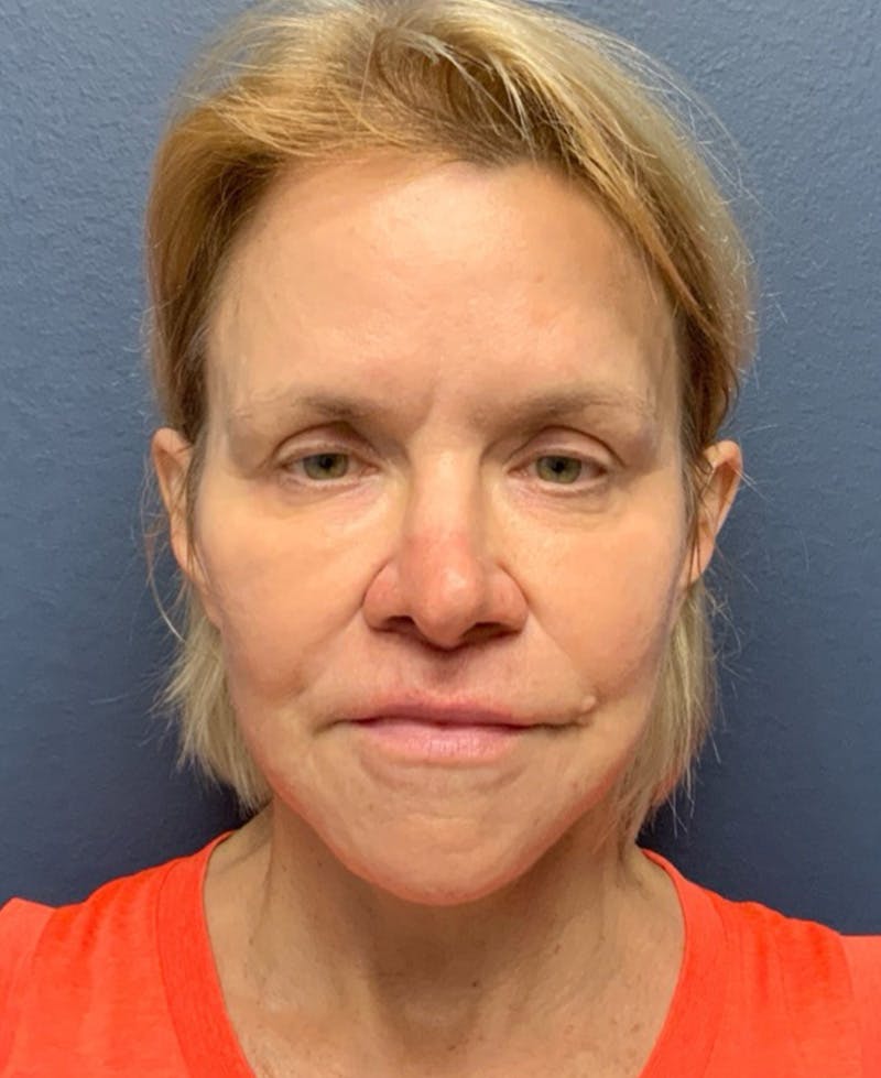 Face Lift Before & After Gallery - Patient 354892 - Image 5