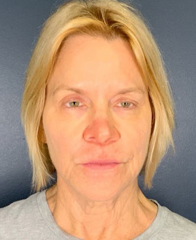 Face Lift Before & After Gallery - Patient 354892 - Image 1