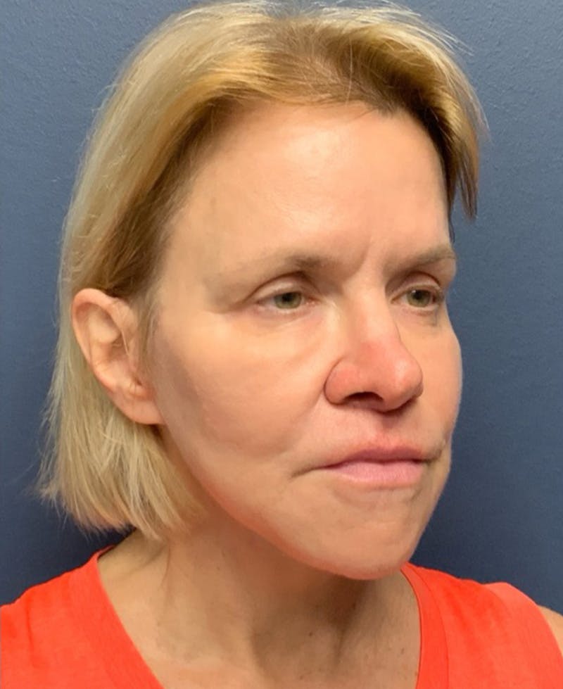Face Lift Before & After Gallery - Patient 354892 - Image 4