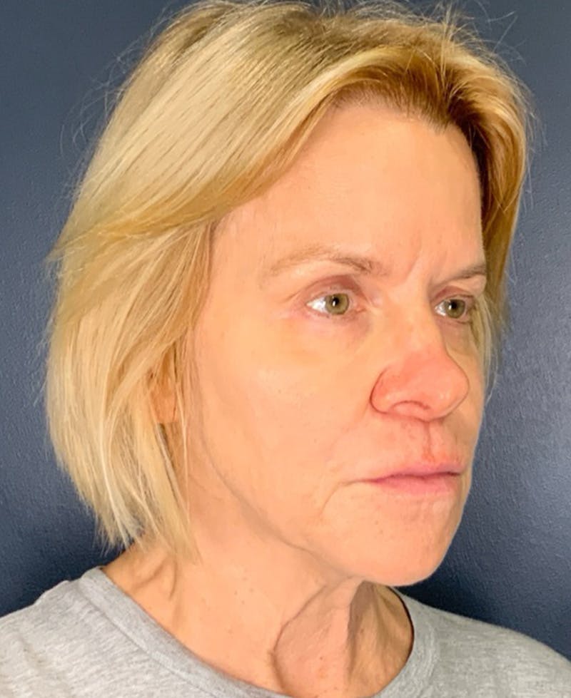Face Lift Before & After Gallery - Patient 354892 - Image 7