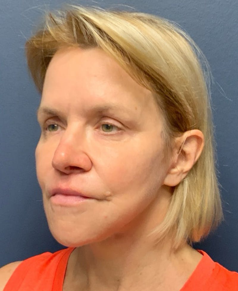 Face Lift Before & After Gallery - Patient 354892 - Image 6