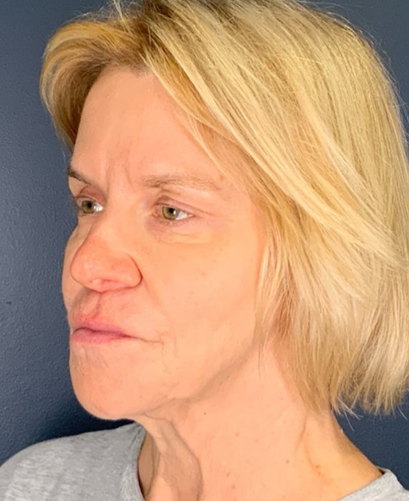 Face Lift Before & After Gallery - Patient 354892 - Image 3