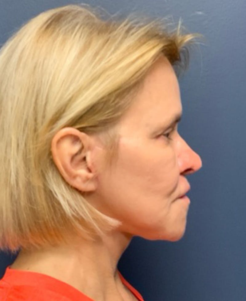 Face Lift Before & After Gallery - Patient 354892 - Image 2