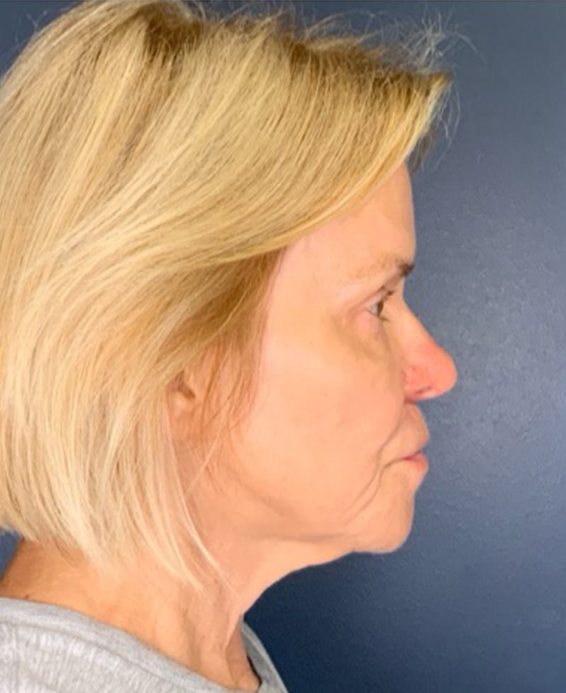 Face Lift Before & After Gallery - Patient 354892 - Image 8