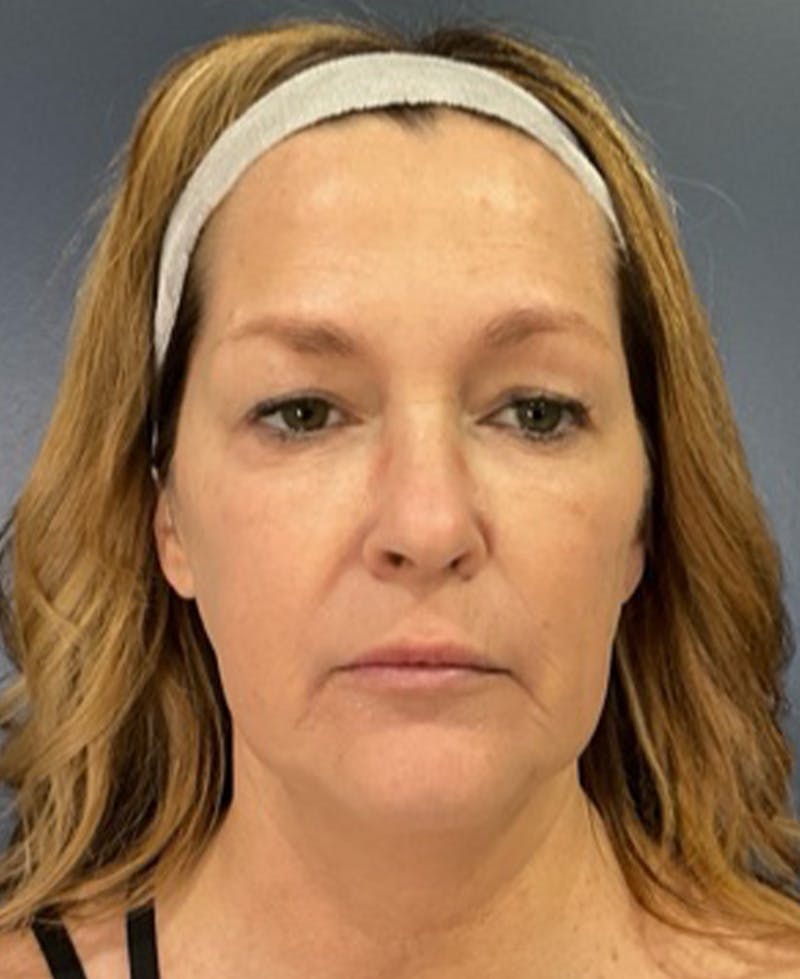 Face Lift Before & After Gallery - Patient 216304 - Image 1