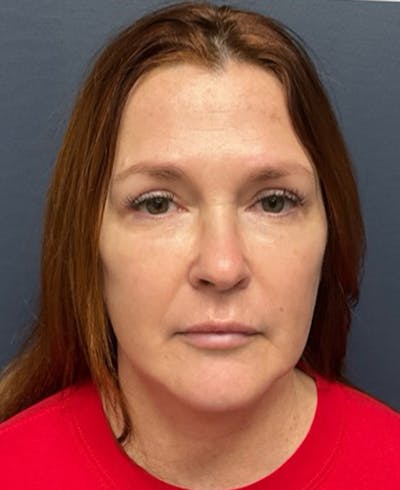 Face Lift Before & After Gallery - Patient 216304 - Image 2