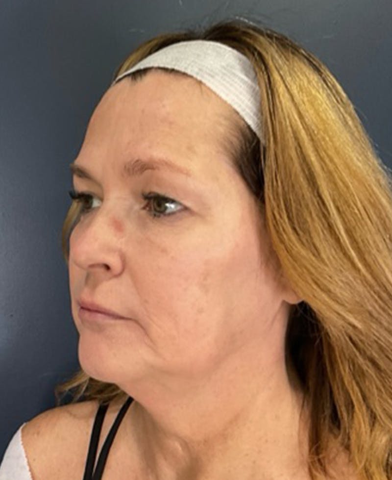 Face Lift Before & After Gallery - Patient 216304 - Image 3