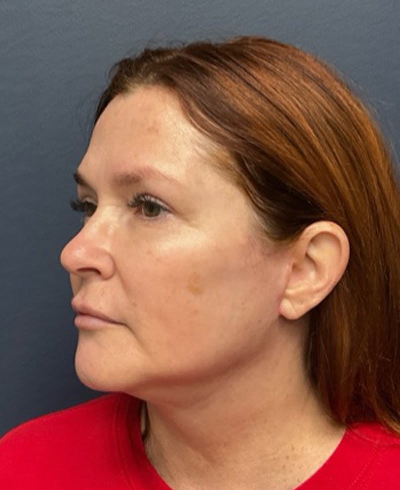 Face Lift Before & After Gallery - Patient 216304 - Image 4