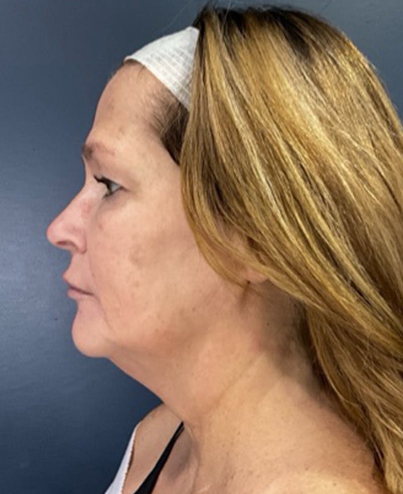 Face Lift Before & After Gallery - Patient 216304 - Image 5