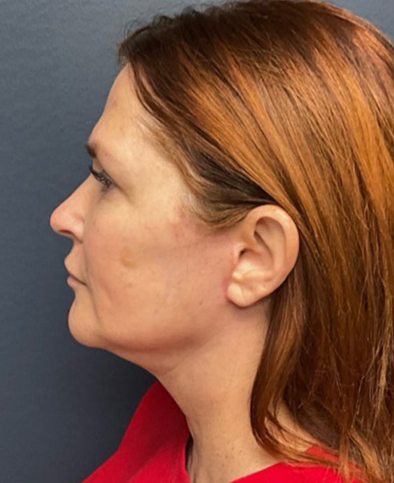 Face Lift Before & After Gallery - Patient 216304 - Image 6