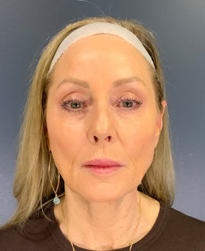 Face Lift Before & After Gallery - Patient 256855 - Image 1