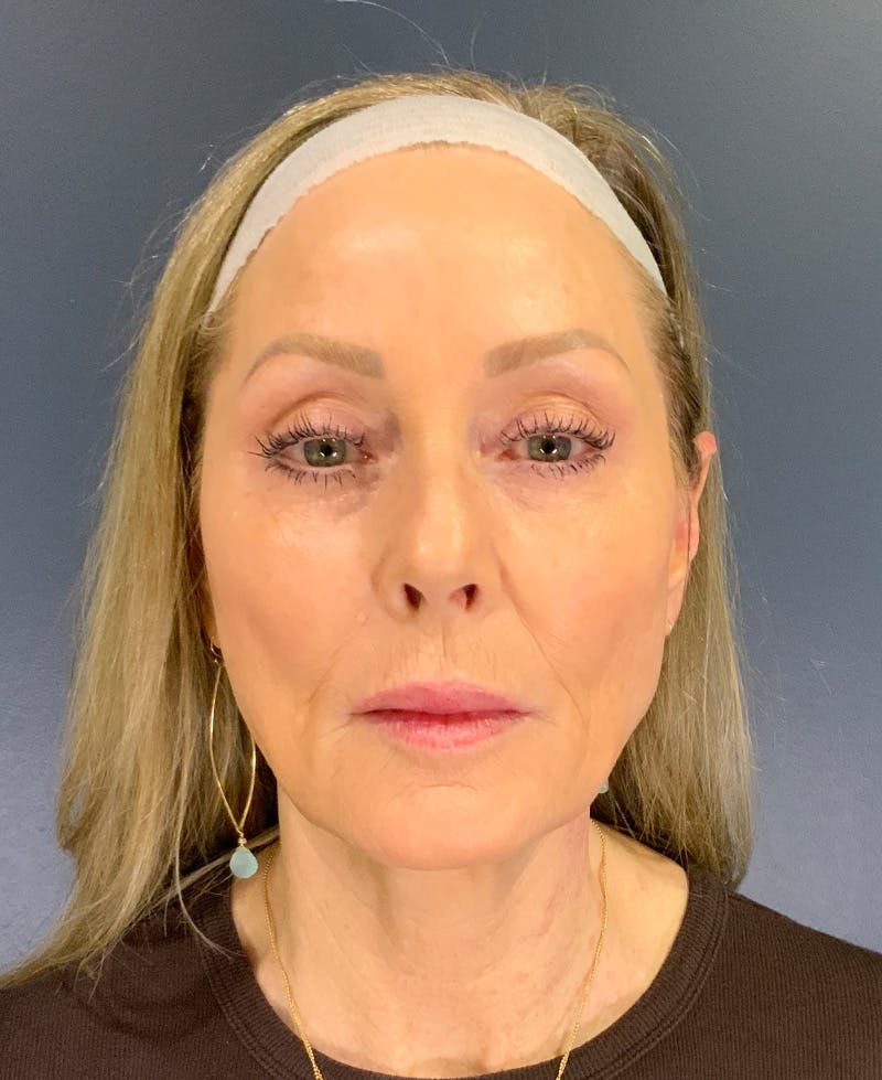 Face Lift Before & After Gallery - Patient 256855 - Image 1