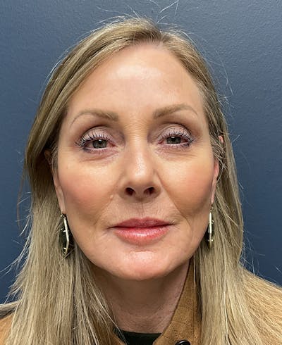 Face Lift Before & After Gallery - Patient 256855 - Image 2