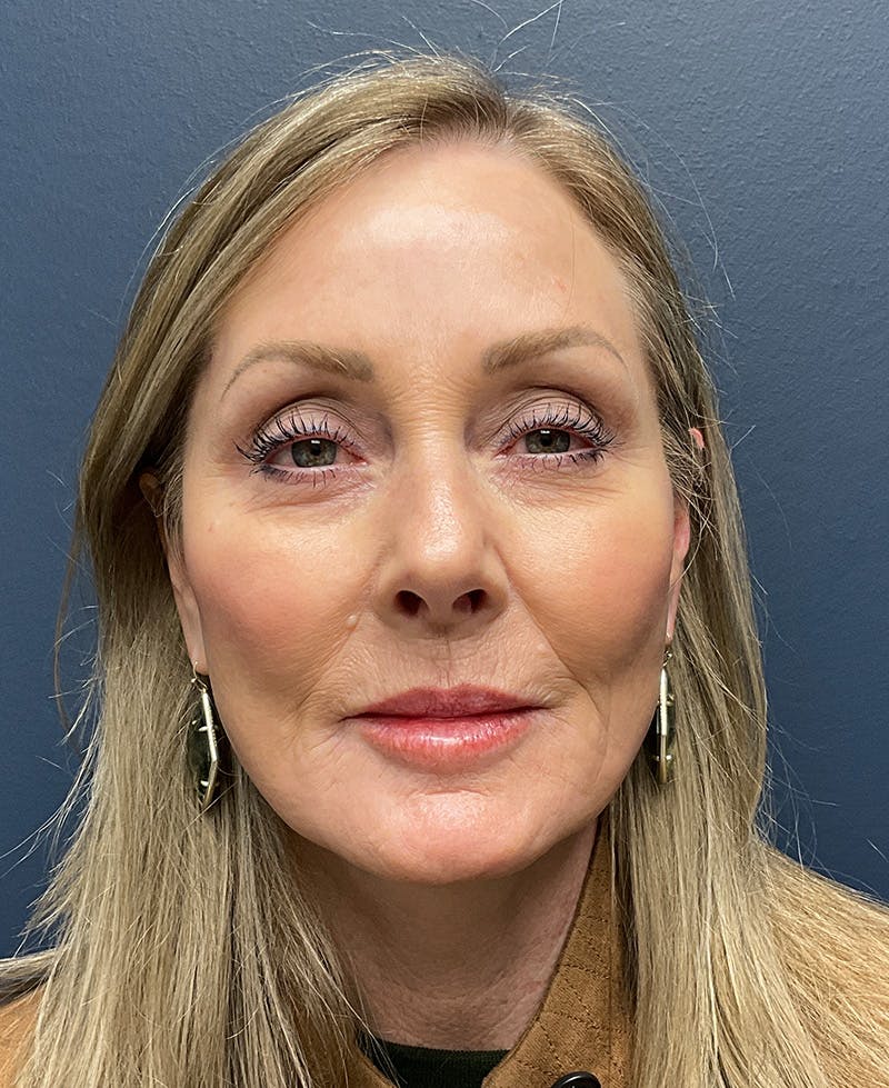 Face Lift Before & After Gallery - Patient 256855 - Image 2