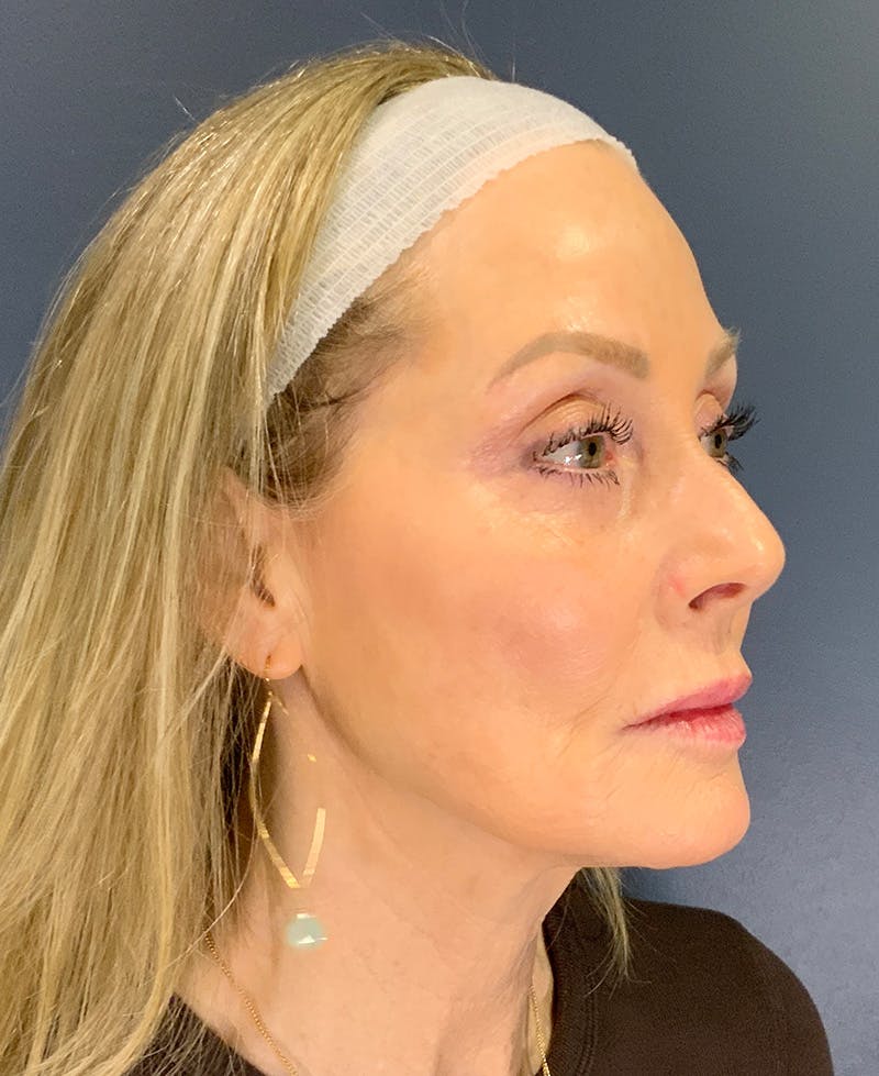 Face Lift Before & After Gallery - Patient 256855 - Image 3
