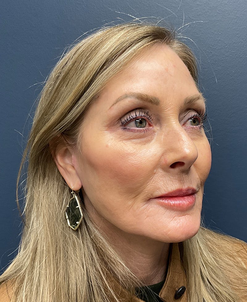 Face Lift Before & After Gallery - Patient 256855 - Image 4