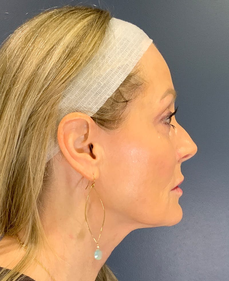 Face Lift Before & After Gallery - Patient 256855 - Image 5