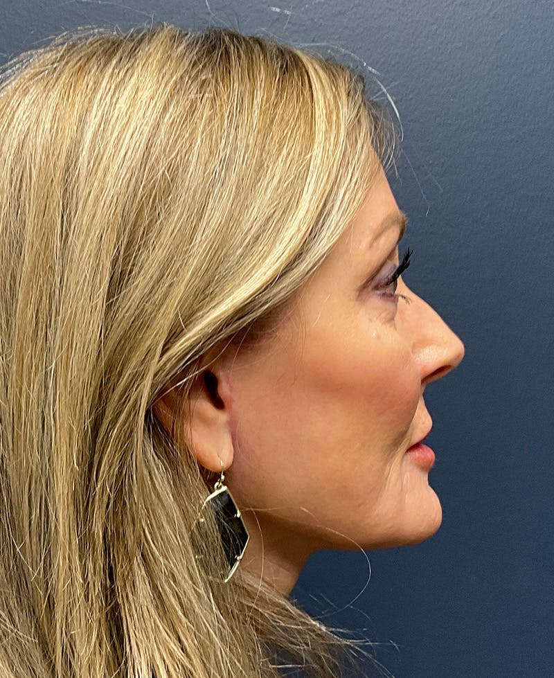 Face Lift Before & After Gallery - Patient 256855 - Image 6