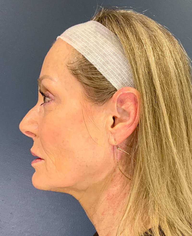 Face Lift Before & After Gallery - Patient 256855 - Image 7