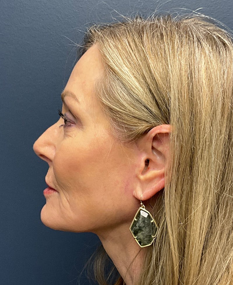 Face Lift Before & After Gallery - Patient 256855 - Image 8