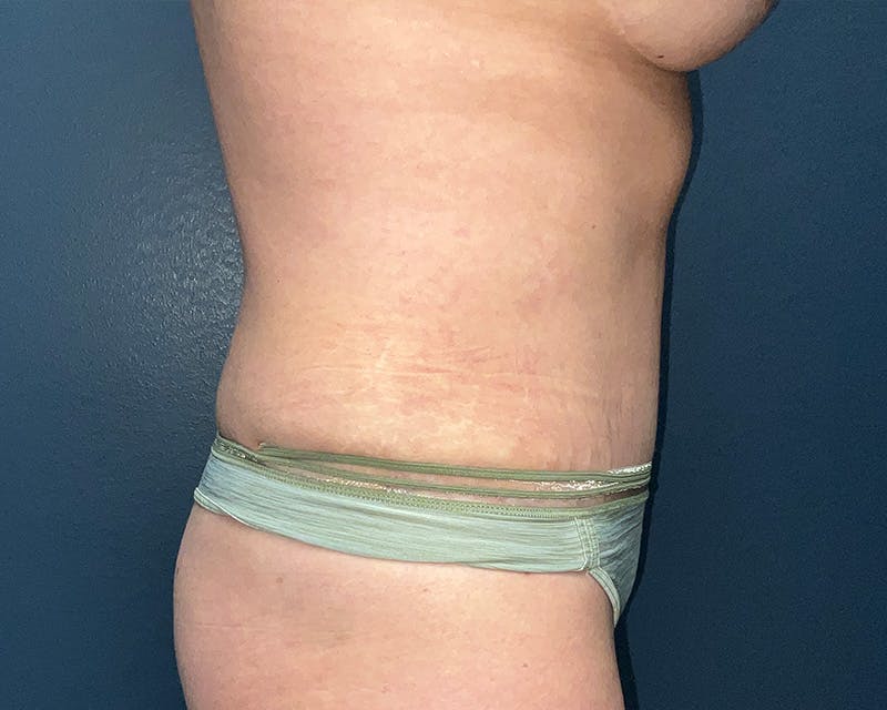 Tummy Tuck Before & After Gallery - Patient 150047 - Image 6