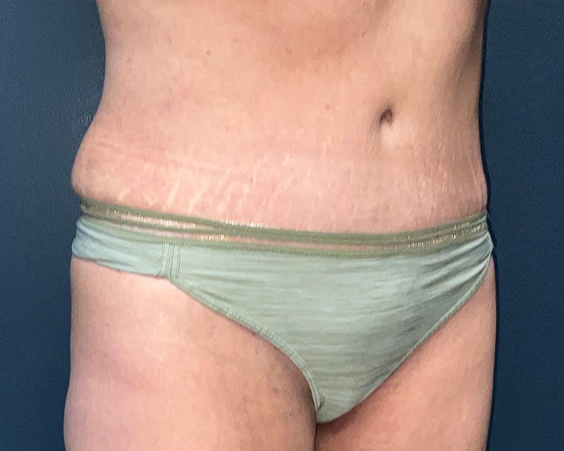 Tummy Tuck Before & After Gallery - Patient 150047 - Image 4