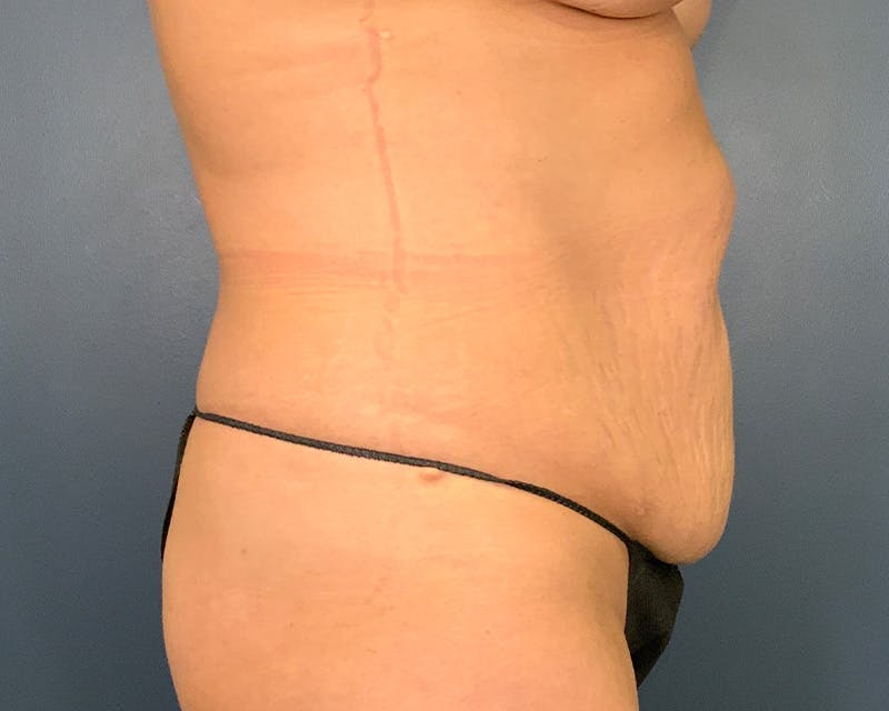Tummy Tuck Before & After Gallery - Patient 150047 - Image 5
