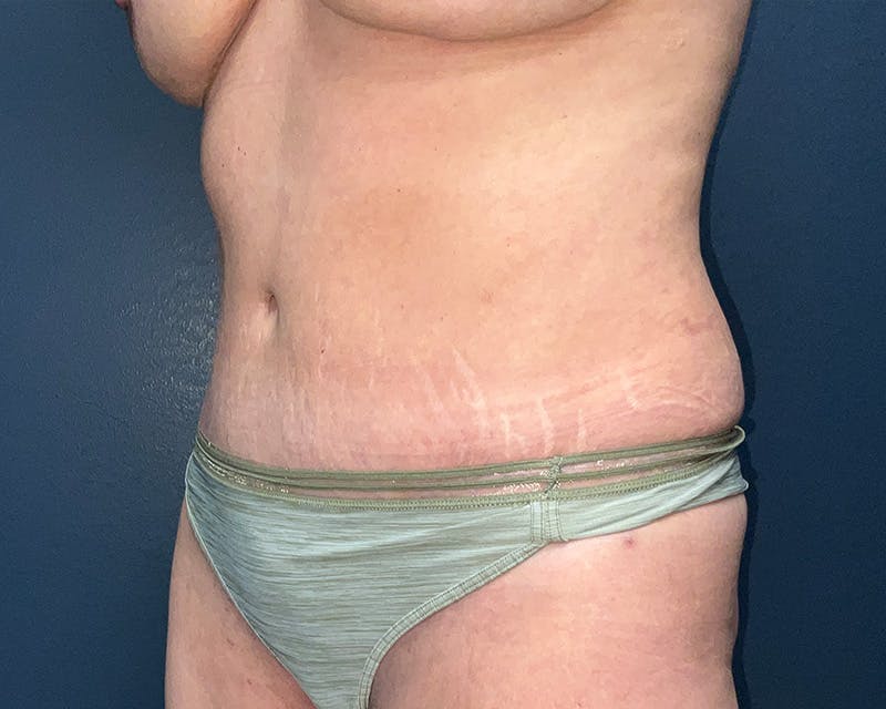 Tummy Tuck Before & After Gallery - Patient 150047 - Image 8